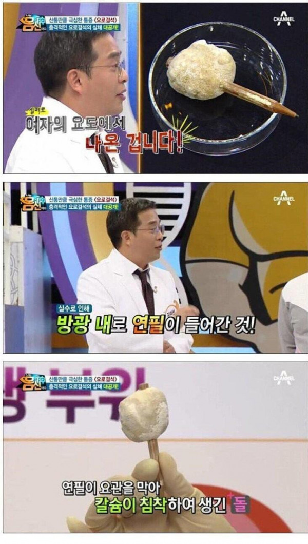 여자 요도 결석의 레전드 ㄷ ㄷ ㄷ